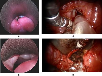 Transoral Robotic Surgery for Early-T Stage Glottic Cancer Involving the Anterior Commissure—News and Update